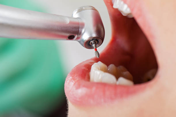 Best Emergency Dental Care for Abscessed Tooth in Ross, CA